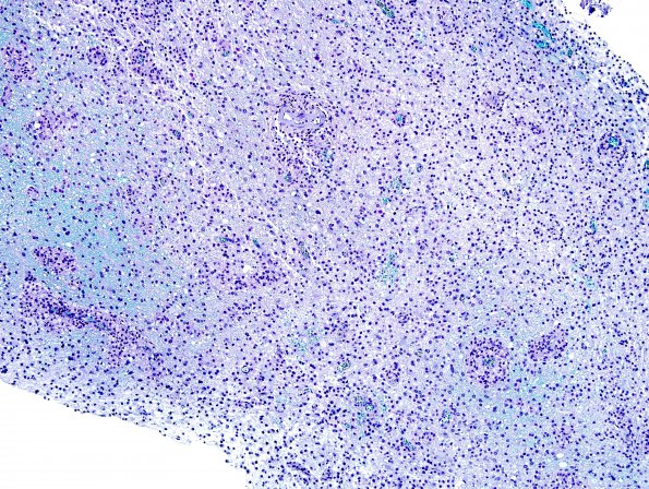 13B2 Inflammatory demyelination (Case 13) LFB-PAS 10X 2