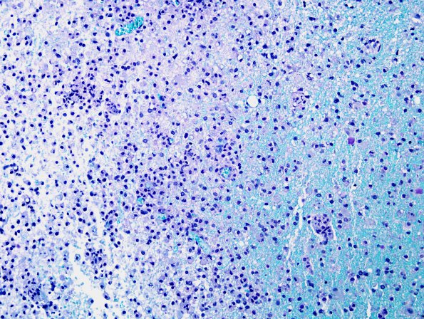 13B3 Inflammatory demyelination (Case 13) LFB-PAS 20X