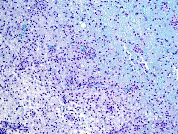 13B4 Inflammatory demyelination (Case 13) LFB-PAS 20X