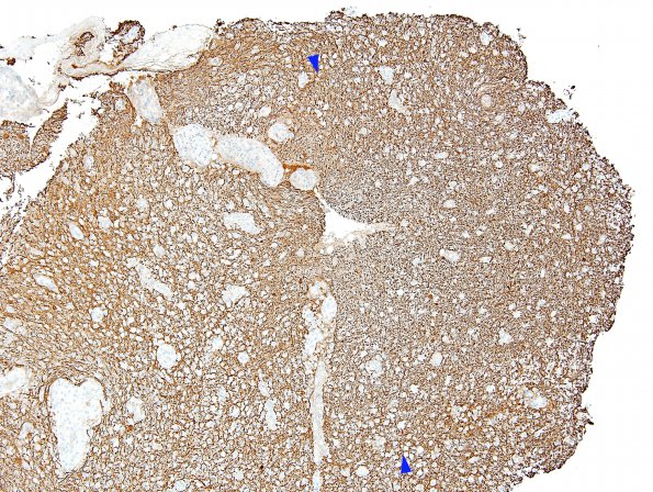 13C1 Inflammatory demyelination (Case 13) Area 1 10X NFil copy