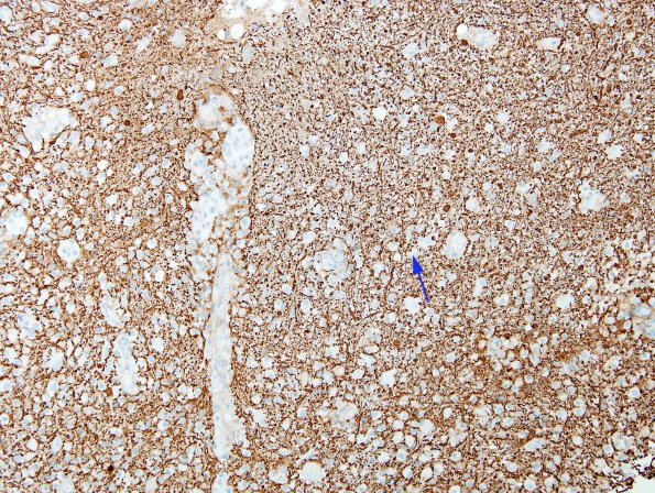 13C2 Inflammatory demyelination (Case 13) Area 1 NFil 1 copy