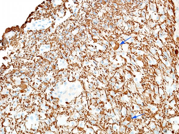 13C3 Inflammatory demyelination (Case 13) NFil 2 copy