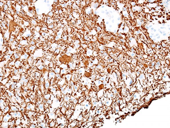 13C4 Inflammatory demyelination (Case 13) NFil 1