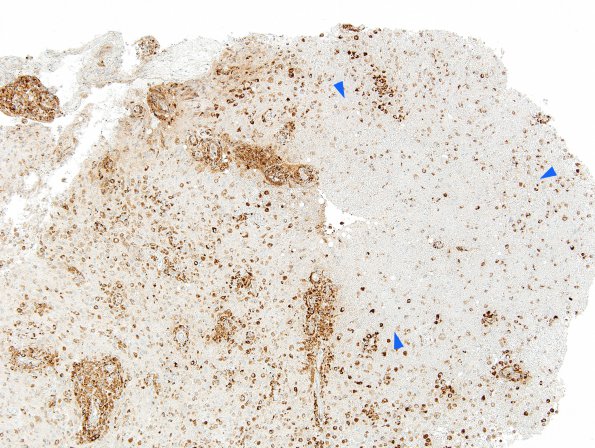 13D1 Inflammatory demyelination (Case 13) Area 1 10X CD-68 copy