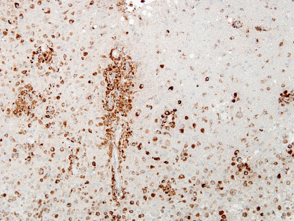 13D2 Inflammatory demyelination (Case 13) Area 1 CD-68