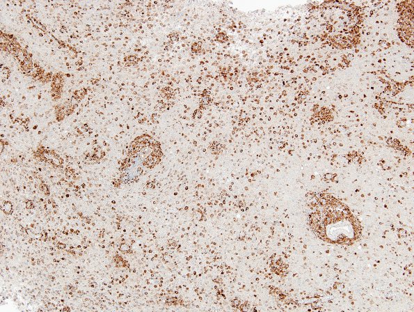 13D3 Inflammatory demyelination (Case 13) CD-68 1