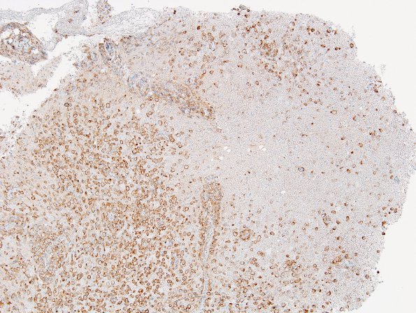 13E1 Inflammatory demyelination (Case 13) Area 1 10X CD-163