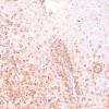 13E2 Inflammatory demyelination (Case 13) Area 1 10X CD-163