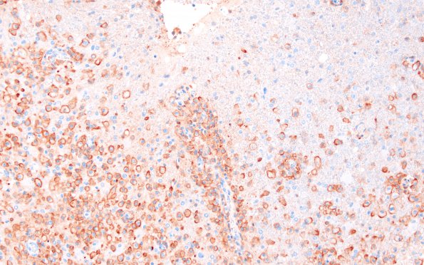 13E2 Inflammatory demyelination (Case 13) Area 1 10X CD-163