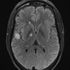 14A Inflammatory Demyelination (Case 14) FLAIR A - Copy - Copy