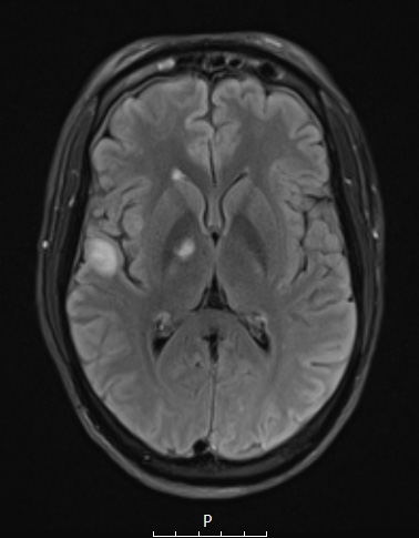 14A Inflammatory Demyelination (Case 14) FLAIR A - Copy - Copy