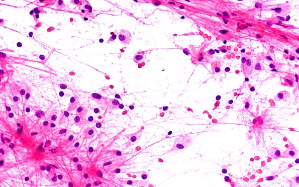 14B1 Inflammatory Demyelination (Case 14) Smear 40X 1