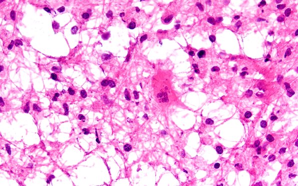 14B10 Inflammatory Demyelination (Case 14) FS 60X 2