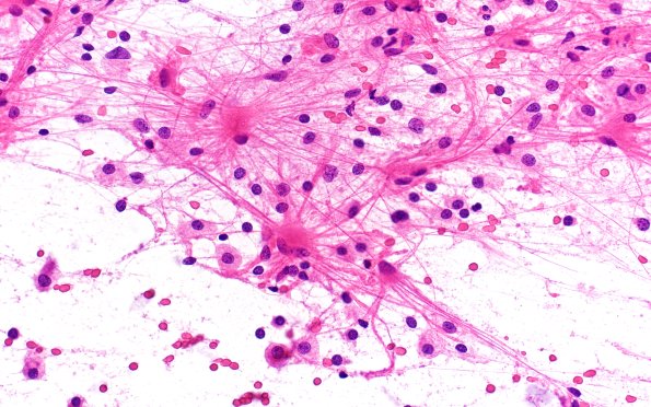 14B2 Inflammatory Demyelination (Case 14) Smear 40X 2