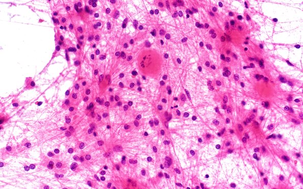 14B3 Inflammatory Demyelination (Case 14) Smear 40X 3