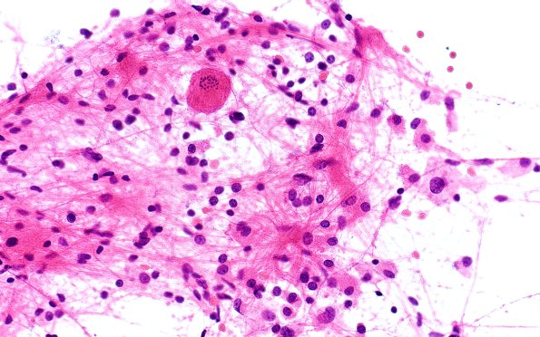14B4 Inflammatory Demyelination (Case 14) Smear 40X 4