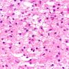14B6 Inflammatory Demyelination (Case 14) FS 40X 2