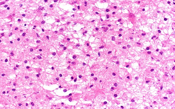 14B6 Inflammatory Demyelination (Case 14) FS 40X 2