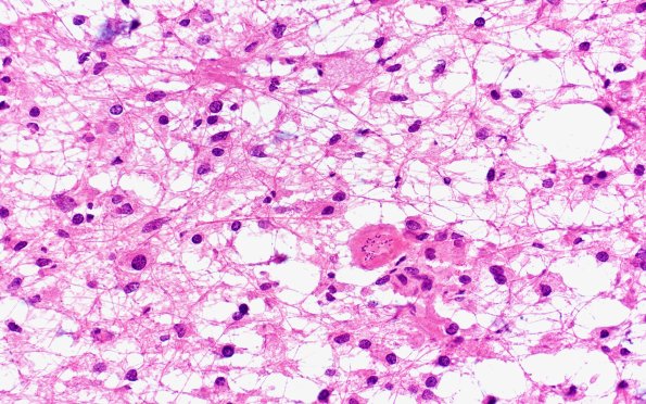 14B7 Inflammatory Demyelination (Case 14) FS 40X