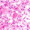 14B8 Inflammatory Demyelination (Case 14) FS 40X 4