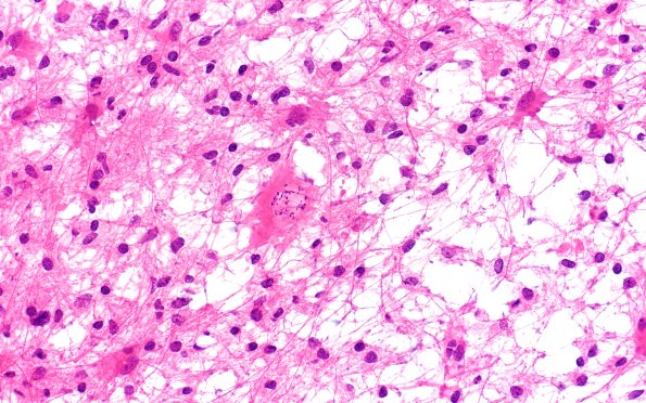 14B8 Inflammatory Demyelination (Case 14) FS 40X 4