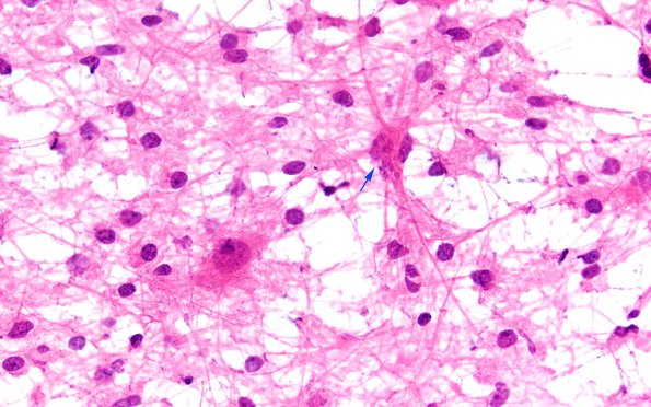 14B9 Inflammatory Demyelination (Case 14) FS 40X 3 copy