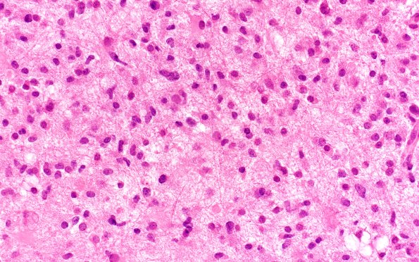 14C1 Inflammatory Demyelination (Case 14) 40X 2