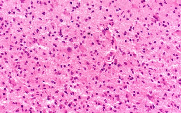 14C2 Inflammatory Demyelination (Case 14) 40X