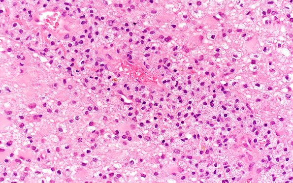 14C3 Inflammatory Demyelination (Case 14) 40X 8