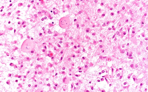 14C5 Inflammatory Demyelination (Case 14) 40X 7