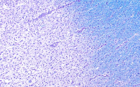 14D1 Inflammatory Demyelination (Case 14) D3 LFB-PAS 10X