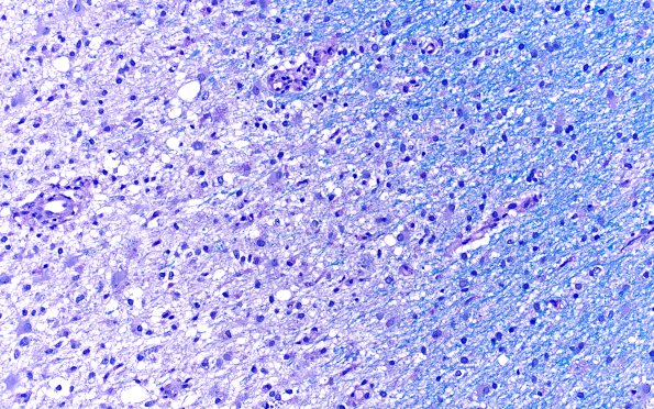 14E1 Inflammatory Demyelination (Case 14) D3 LFB-PAS 20X