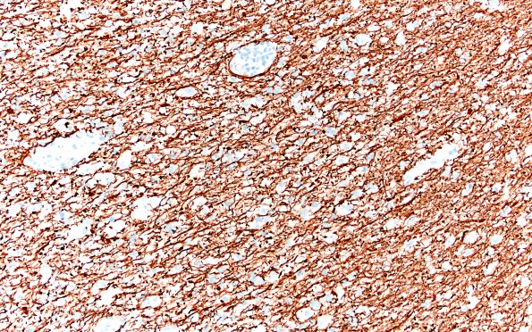 14E2 Inflammatory Demyelination (Case 14) D3 NF 20X