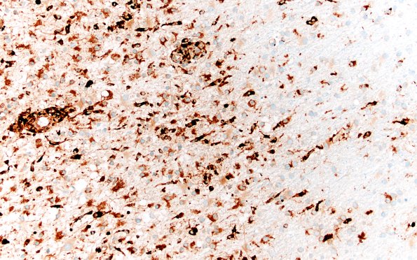 14E3 Inflammatory Demyelination (Case 14) D3 CD68 20X 1