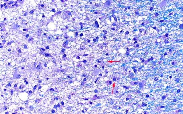 14F1 Inflammatory Demyelination (Case 14) D3 LFB-PAS 40X 1 copy