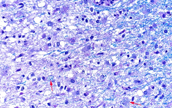 14F2 Inflammatory Demyelination (Case 14) D3 LFB-PAS 40X 2 copy