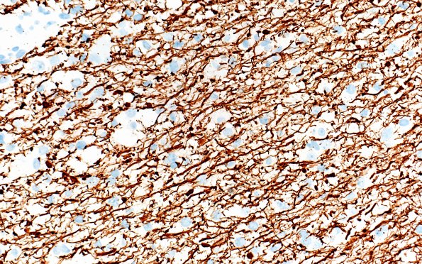 14F3 Inflammatory Demyelination (Case 14) D3 NF 40X