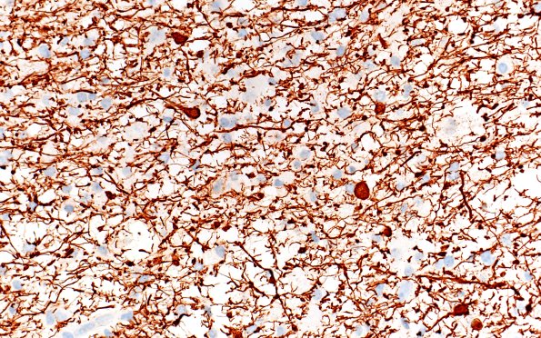 14F4 Inflammatory Demyelination (Case 14) D3 NF 40X 2