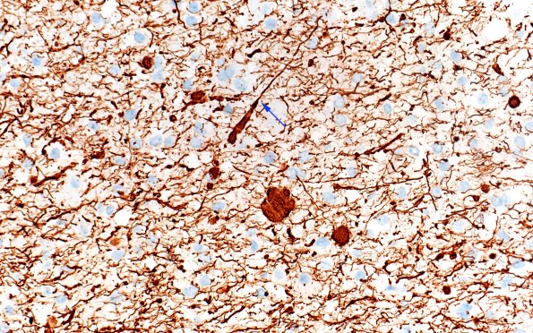 14F5 Inflammatory Demyelination (Case 14) D3 NF 40X OTHER AREA copy