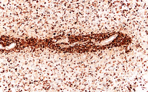 14F6 Inflammatory Demyelination (Case 14) D3 CD68 20X 2