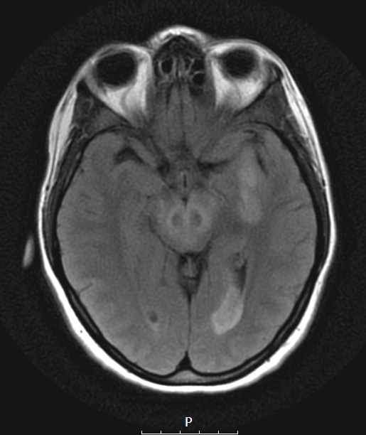 15A1 Inflamm Demyel (Case 15) T2 FLAIR a - Copy