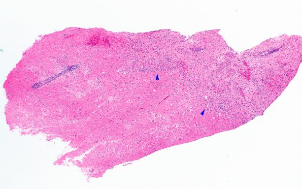 15B1Inflamm Demyel (Case 15) 4X copy