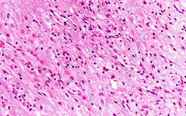 15B3 Inflamm Demyel (Case 15) A2 40X