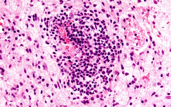 15B4 Inflamm Demyel (Case 15) A2 40X 4