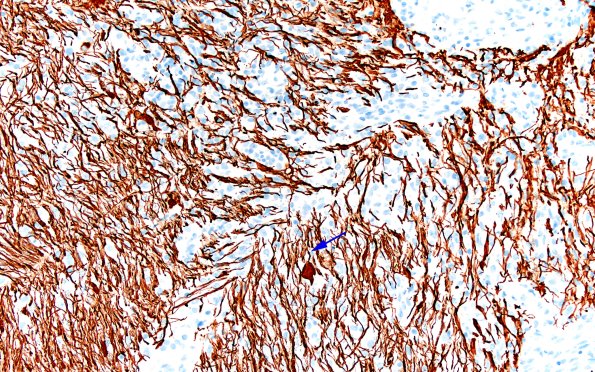 15D2 Inflamm Demyel (Case 15) NF 20X copy
