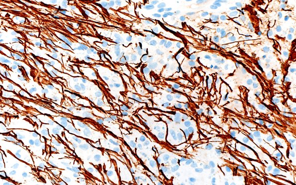 15D3 Inflamm Demyel (Case 15) NF 40X 1