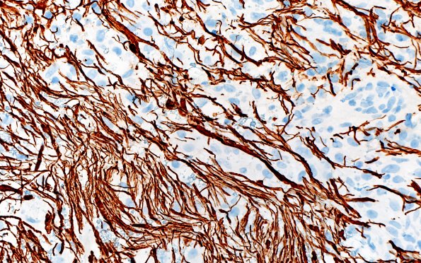 15D4 Inflamm Demyel (Case 15) NF 40X 2 A