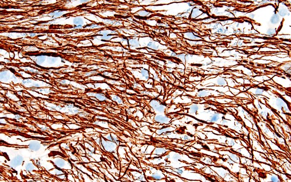 15D5 Inflamm Demyel (Case 15) NF 60X 2