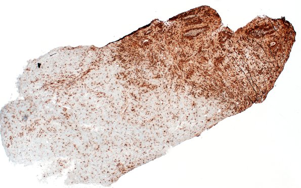 15E1 Inflamm Demyel (Case 15) CD68 4X