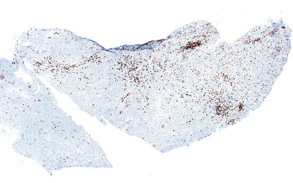15F1 Inflamm Demyel (Case 15) CD3 4X